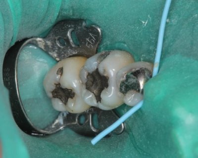 ラバーダムシートの色はどないしょ ブラック ラテックス デンタルダム Self Help Endodontics 知行好楽