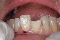 切端と歯冠の修復_01.jpg