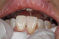 切端と歯冠の修復_02.jpg
