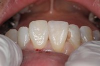 切端と歯冠の修復_03.jpg