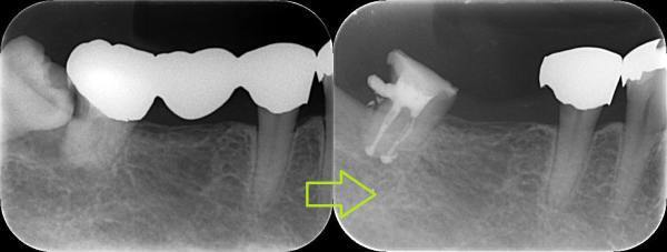 東洋オブチュレーションガッターキット: Self-Help Endodontics~知行好楽