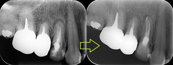 東洋オブチュレーションガッターキット: Self-Help Endodontics~知行好楽