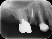 Surgical extrusion_01.Jpg