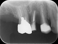 Surgical extrusion_02.Jpg