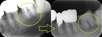 removal of obturation material from root canal.Jpg